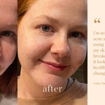 
  
  Personal testimony of acne clearing from A swatch of Ere Perez Moringa All Beauty Crème
  
