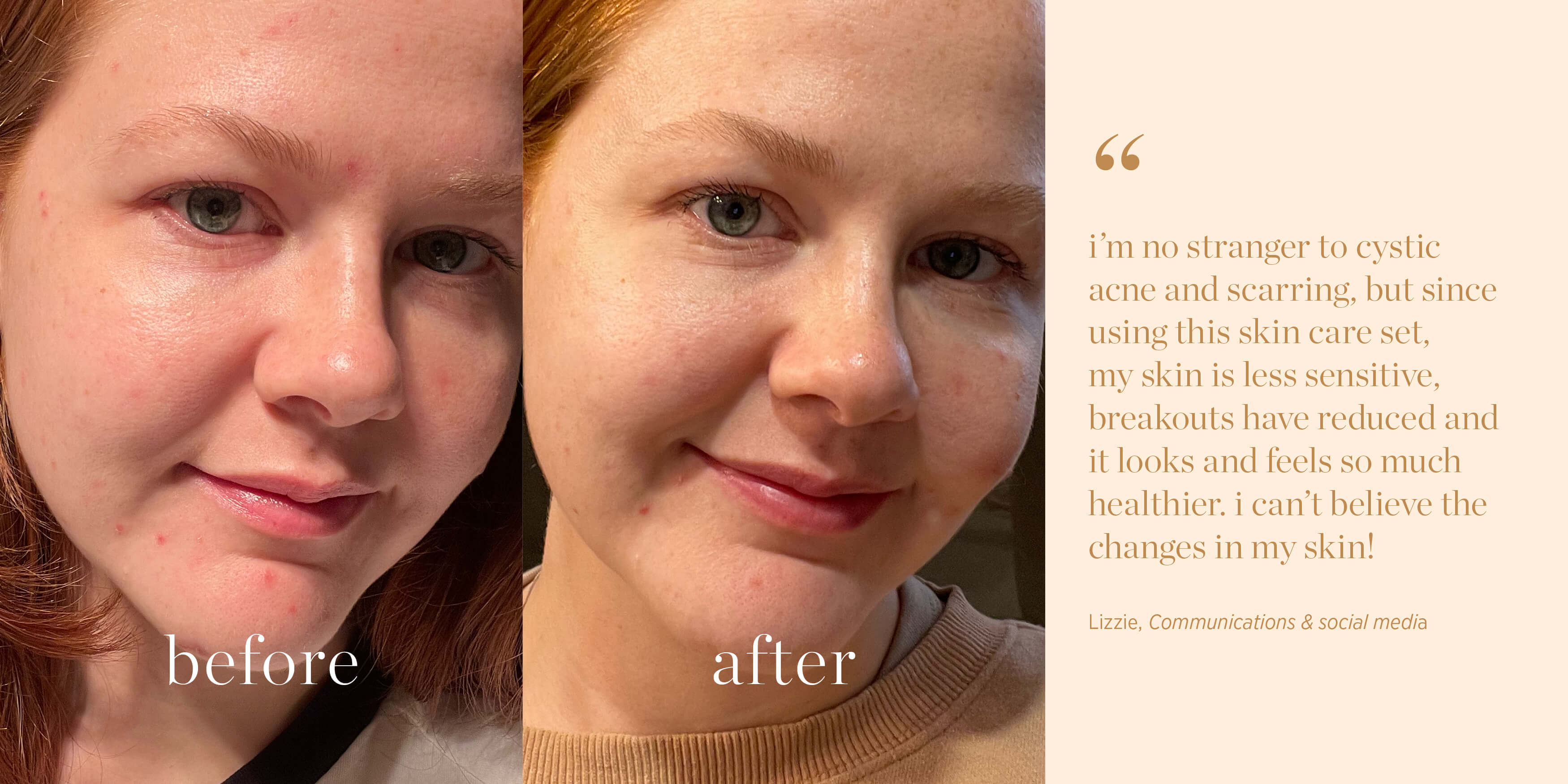 
  
  Personal testimony of acne clearing from A swatch of Ere Perez Moringa All Beauty Crème
  
