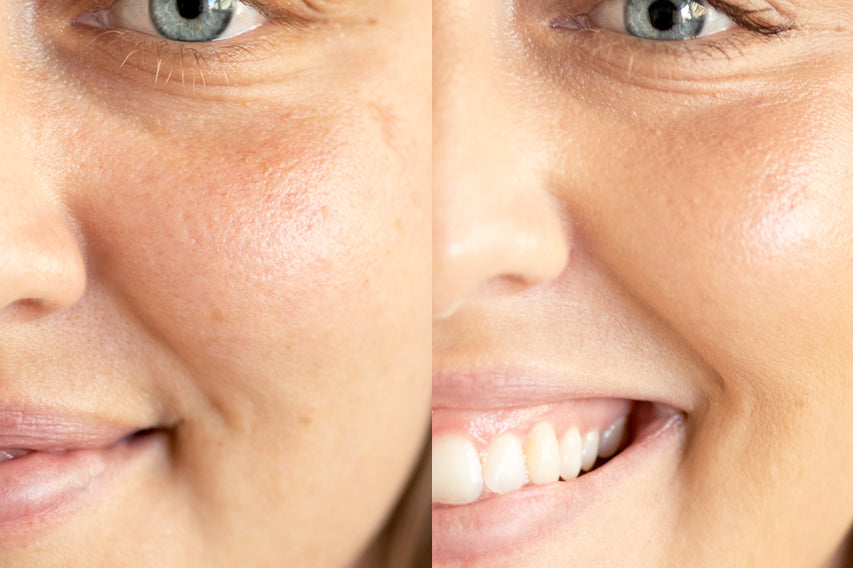 
  
  Before and after application of Ere Perez Lychee Creme Corrector Tres on a woman with light complexion and neutral undertones.
  
