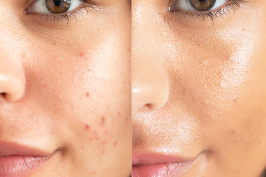 
  
  A before and after of Ere Perez Lychee Creme Corrector Cinco on a woman with medium complexion and golden undertones.
  
