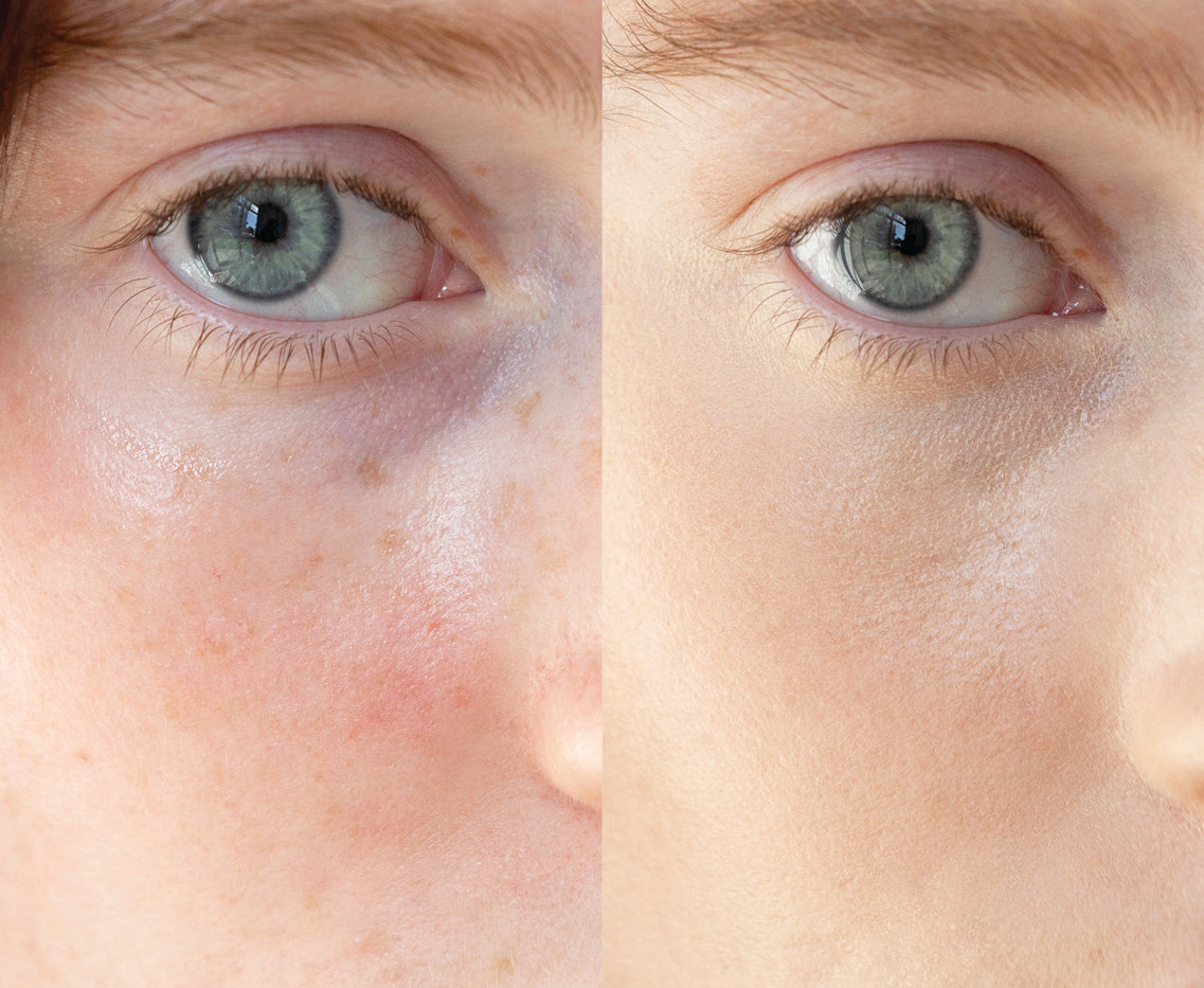 
  
  A close-up comparison of Ere Perez Lychee Creme Corrector Uno on a woman with light complexion and pink undertones.
  
